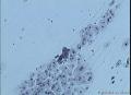38岁，ASC-US？OR  LSIL？图10