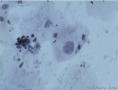 38岁，ASC-US？OR  LSIL？图14