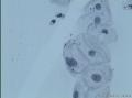 38岁，ASC-US？OR  LSIL？图3