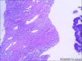 男，59岁肝穿，有癌无？图3