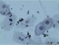 38岁，ASC-US？OR  LSIL？图5