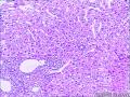 男，59岁肝穿，有癌无？图5