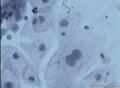 38岁，ASC-US？OR  LSIL？图11