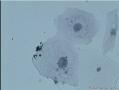 38岁，ASC-US？OR  LSIL？图9