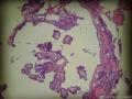 右侧甲状腺肿物，请教图6