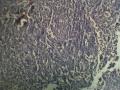 宫内膜，会不会是个低分化腺癌？？图16