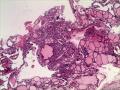 甲状腺结节图3