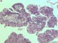 卵巢粘液性囊腺瘤，够癌吗图5