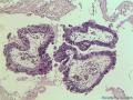 卵巢粘液性囊腺瘤，够癌吗图4