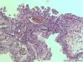 卵巢粘液性囊腺瘤，够癌吗图6