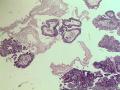 卵巢粘液性囊腺瘤，够癌吗图3