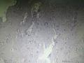 宫颈赘生物图14