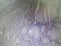 右侧甲状腺包块图12