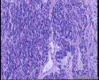 请教：甲状腺峡部肿物。图21