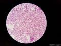 患者，男，45岁，结胸。这是细胞蜡块，请老师帮看看图1