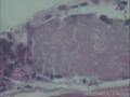 头皮下囊肿图8