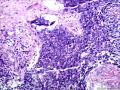 透明细胞癌？浆液性癌？鳞癌？移行细胞癌？图13