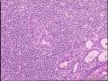 亚甲炎？淋巴组织内滤泡上皮异形增生图22