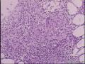 亚甲炎？淋巴组织内滤泡上皮异形增生图2