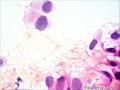 气管分泌物涂片图7