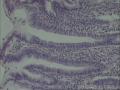 胃窦黏膜 低级别上皮内瘤变图14