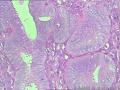 宫腔刮出物--觉得局灶够非典了图9