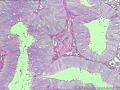 宫腔刮出物--觉得局灶够非典了图8