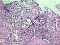 食管活检组织，高级别？癌？图5