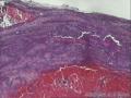 涎腺多形性腺瘤？图9