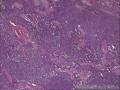 涎腺多形性腺瘤？图11