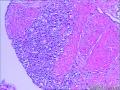 男，70岁，前列腺穿刺组织待诊图6