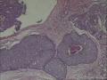 左乳外上象限包块，髓样癌？图3