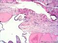 甲状腺肿物图6