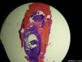 扁桃体上极肿物图8