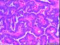 滤泡性癌还是滤泡性乳头状癌？图7