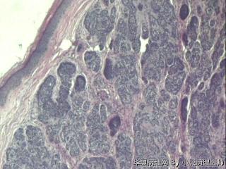 请教，右下肢小腿肿物，毛发上皮瘤还是基底细胞瘤？图1