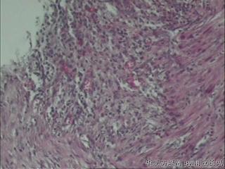 附睾炎性坏死还是肿瘤？请教老师了图19
