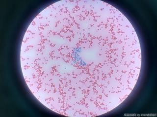 暗红色胸腔积液，临床高度怀疑肺癌图16