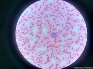 暗红色胸腔积液，临床高度怀疑肺癌图13