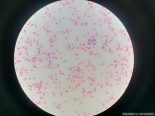 暗红色胸腔积液，临床高度怀疑肺癌图8