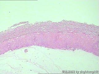 宫颈活检--CIN2?图1