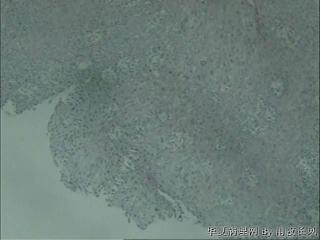 食管黏膜，是微浸润还是切面问题？图2