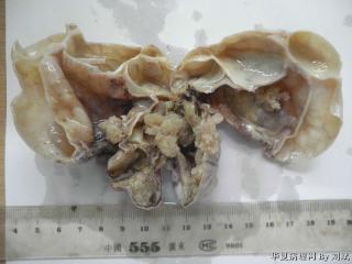 请老师们看看这个卵巢肿块图1