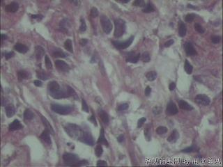 胃窦黏膜，低分化还是印戒？图6