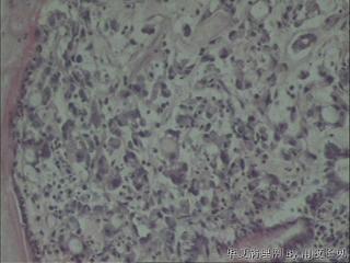 胃窦黏膜，低分化还是印戒？图13