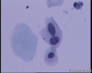 55岁，宫颈液基，萎缩？有不典型吗？图2