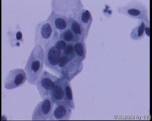 55岁，宫颈液基，萎缩？有不典型吗？图3