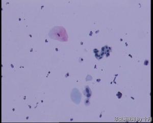 55岁，宫颈液基，萎缩？有不典型吗？图1