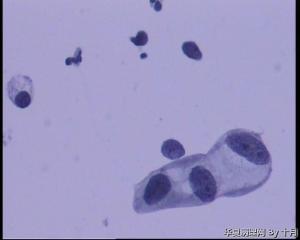 55岁，宫颈液基，萎缩？有不典型吗？图9