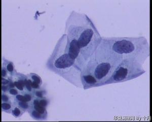55岁，宫颈液基，萎缩？有不典型吗？图5